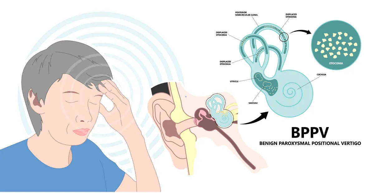 BPPV (Benign Paroxysmal Positional Vertigo) Demystified: Diagnosis and Care