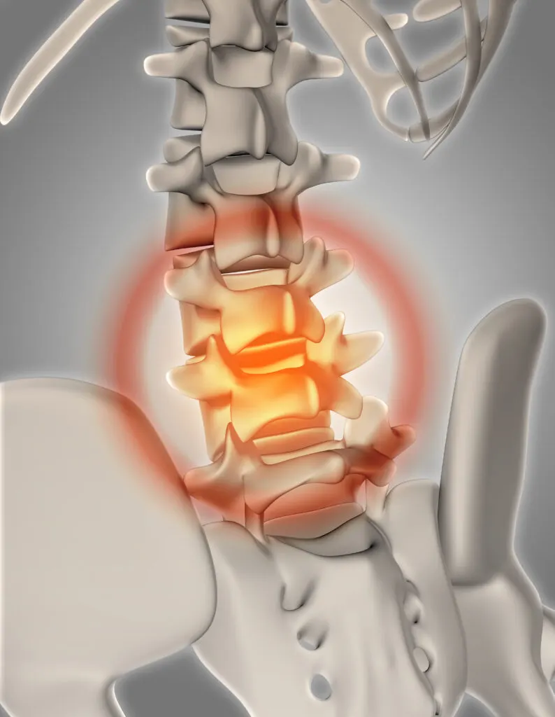 Everything You Need To Know About Disc Herniation