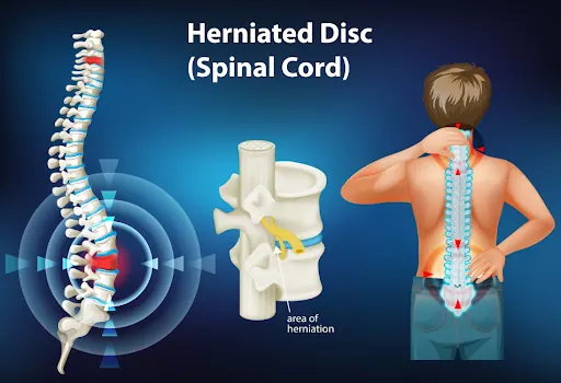 Herniated Disc