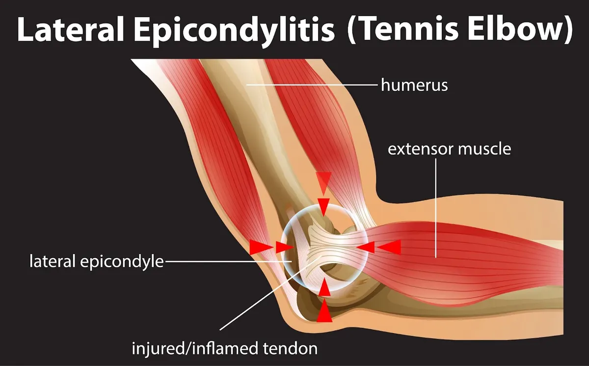 Tennis Elbow: What Is It and How Chiropractic Care Can Help