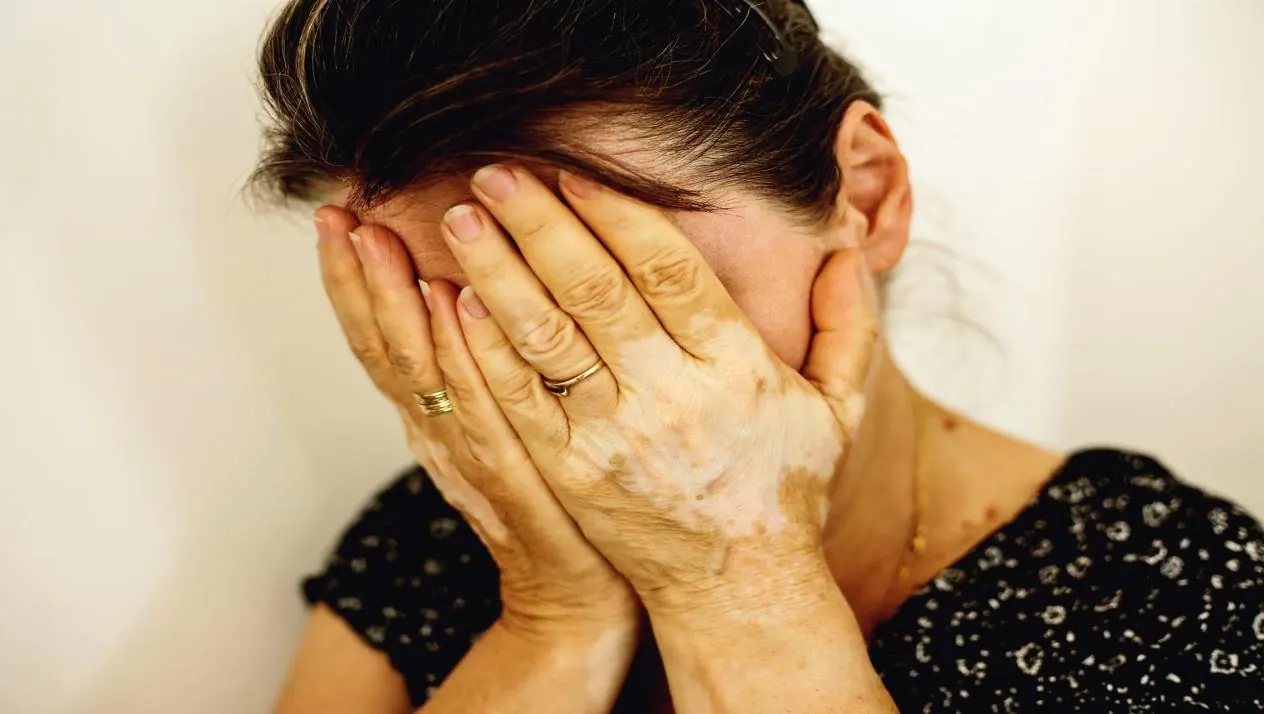 woman has white spots in hands due to autoimmune diesease