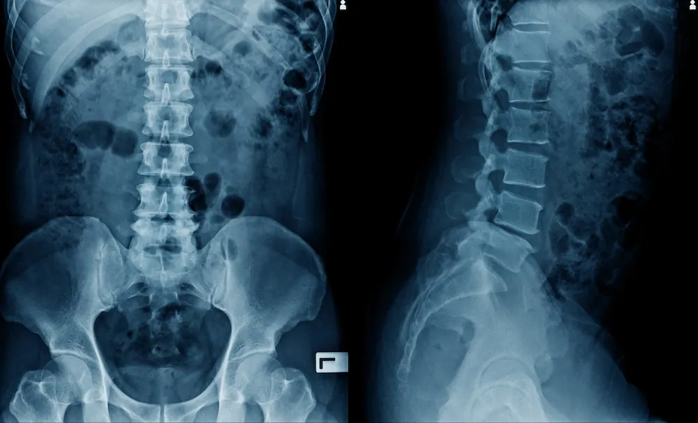 spine xray result for hip pain