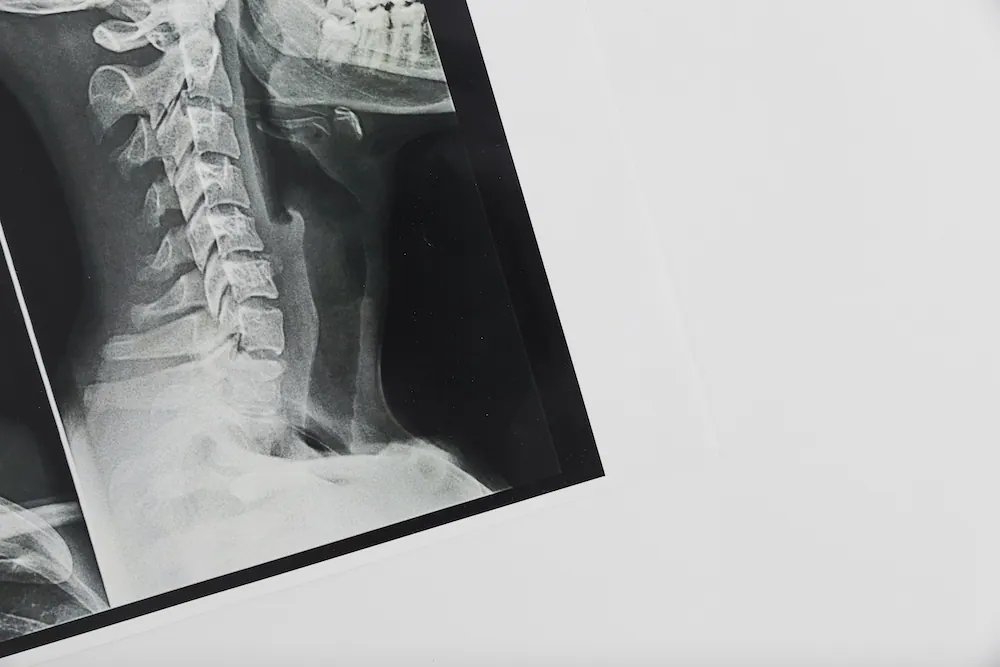 neck xray result